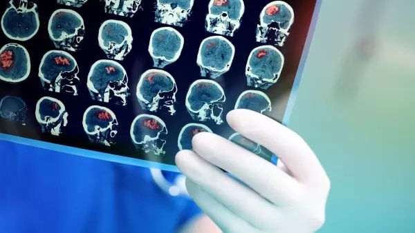 Енцефалопатія: як вчасно розпізнати ураження мозку?