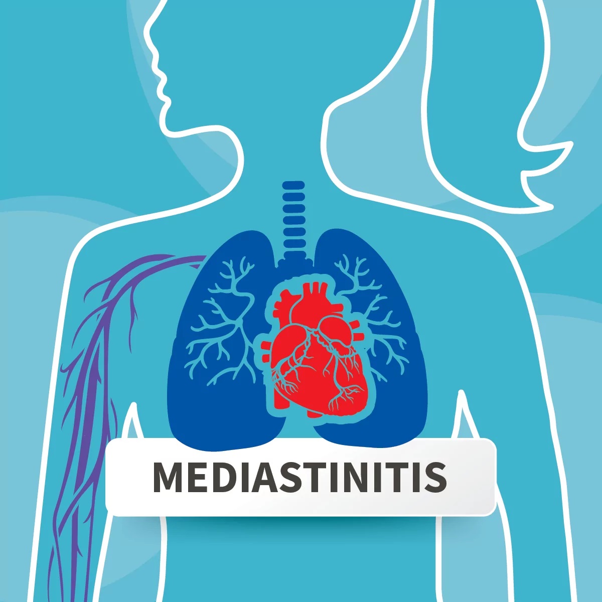 Медіастиніт: симптоми запалення тканини грудної клітки 