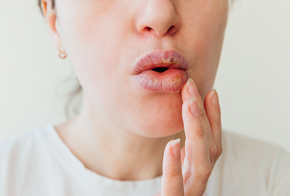Основні причини набряку губ