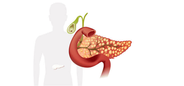 Некротичний панкреатит: основні симптоми ураження підшлункової залози 