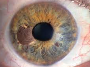Пигментная глаукома — что это, почему возникает и как лечить