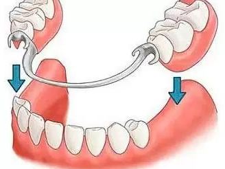 Что такое стоматологический имплантат 