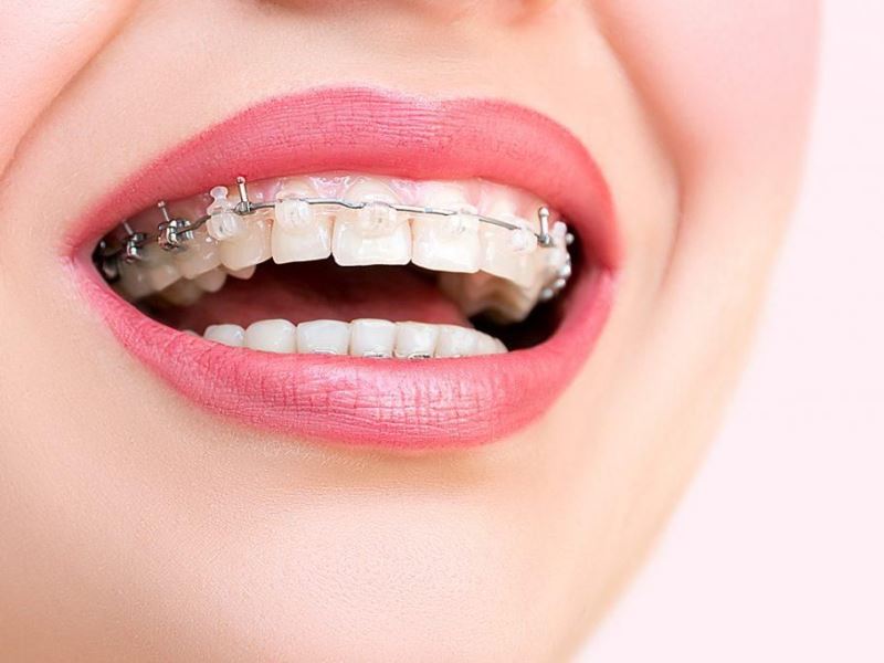 Выравнивание зубов: с помощью чего и где можно это сделать 