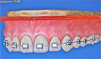Ортодонтическая фиксация