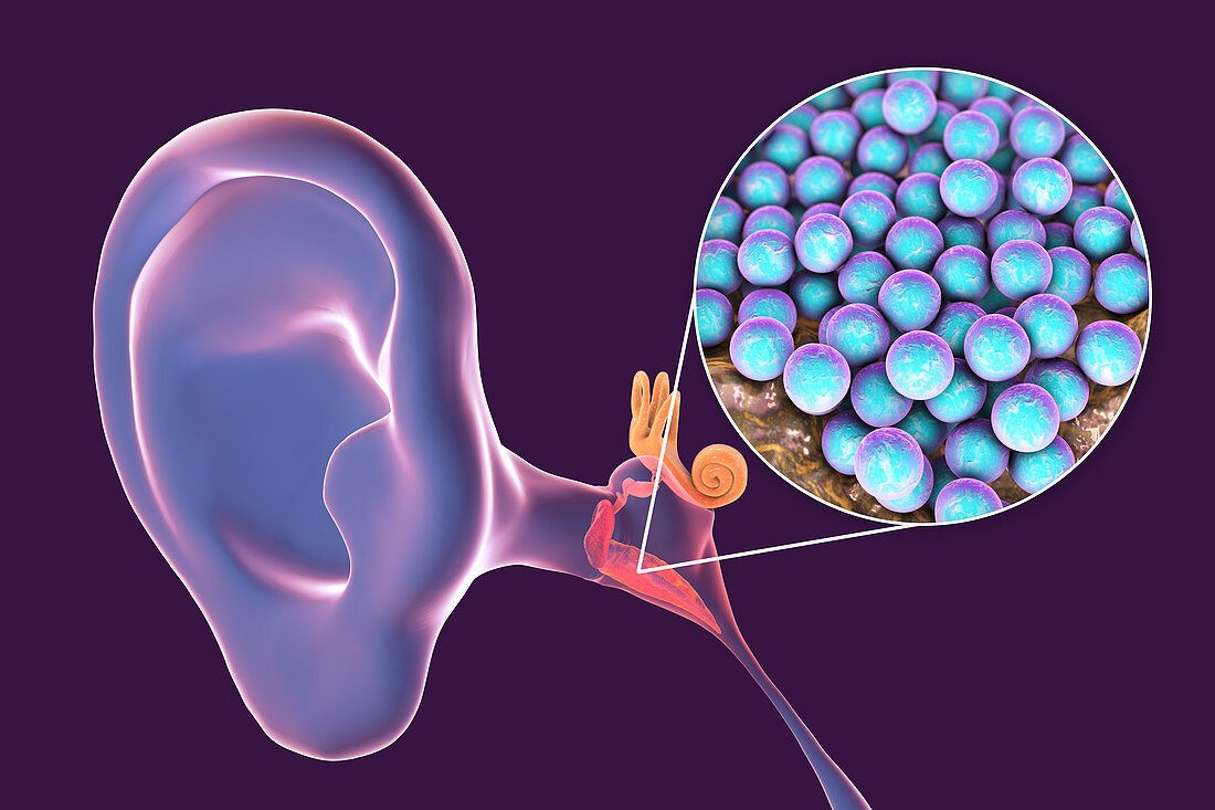 Гострий середній отит: основні симптоми запалення вуха