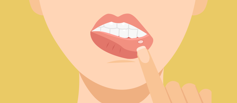 Основні причини появи виразки в роті
