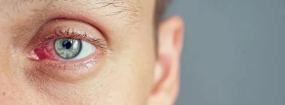 Акантамебний кератит: основні симптоми інфекції очей