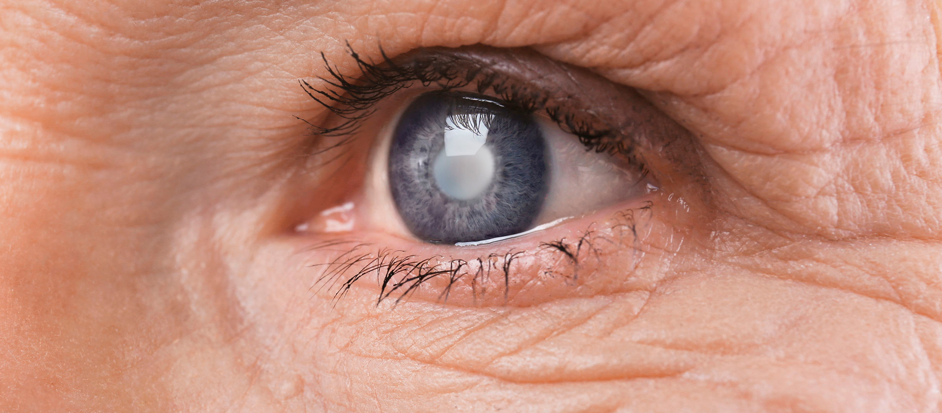 Катаракта: ранні прояви порушення зору