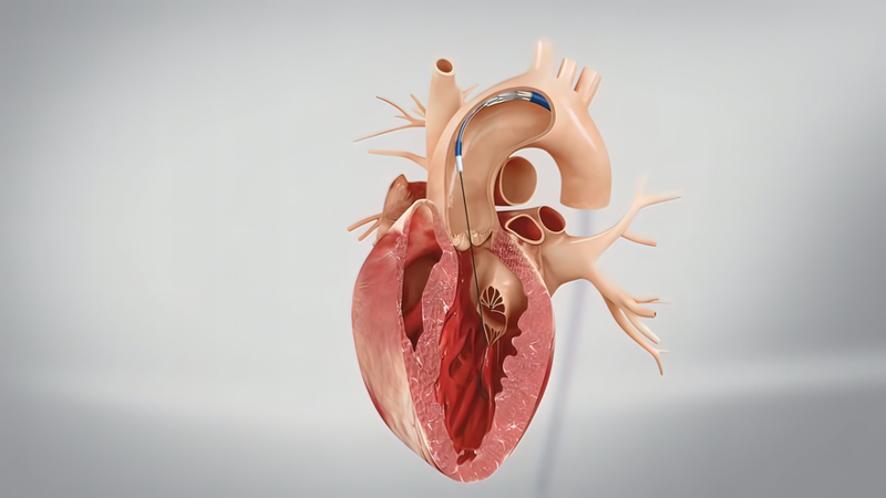 Звуження аорти: основні симптоми вродженої вади серця