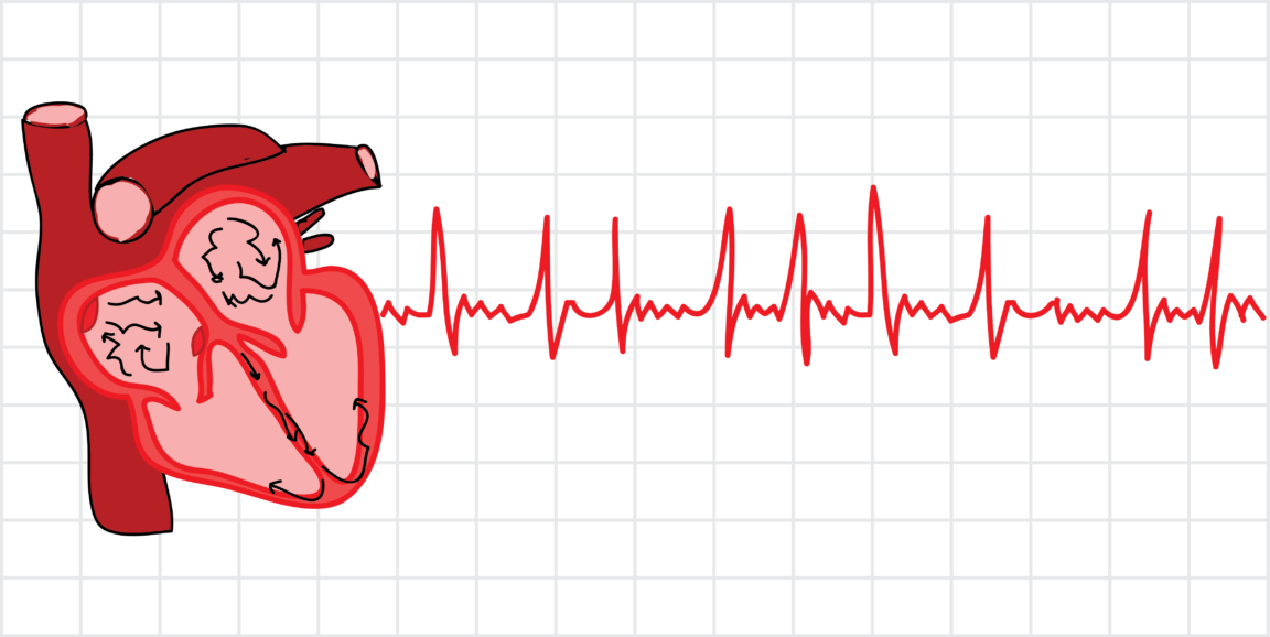 Фібриляція передсердь: основні симптоми порушення серцебиття
