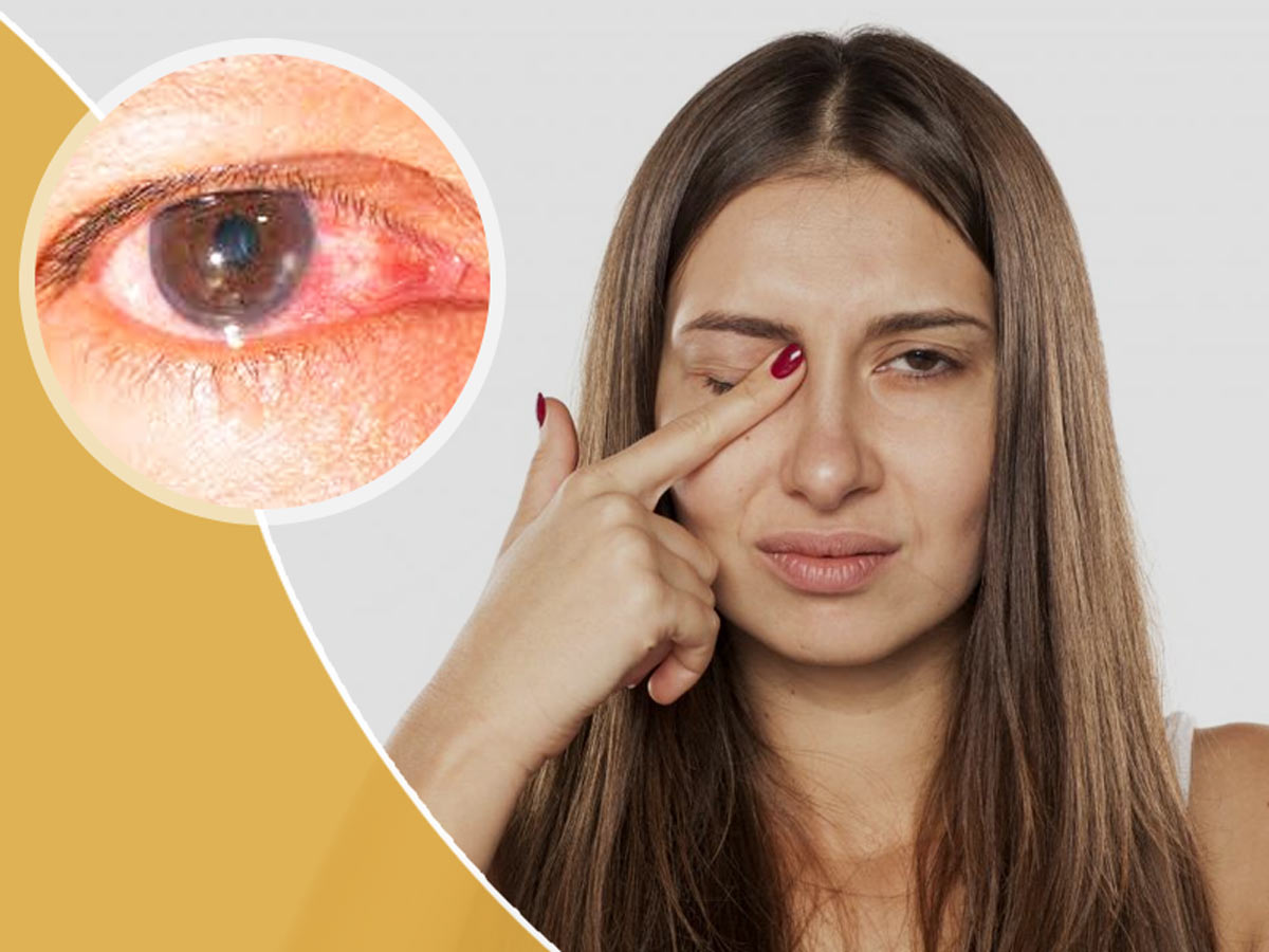 Кератит: основні симптоми запалення рогівки ока
