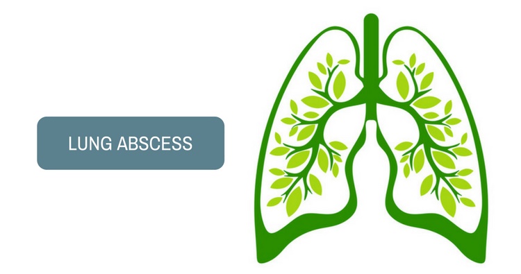 Абсцес легені: основні симптоми та методи лікування
