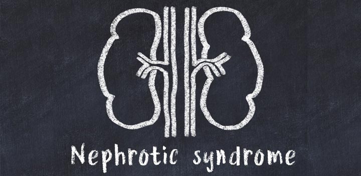Нефротичний синдром: основні симптоми ураження нирок