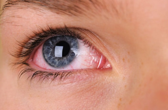 Хімічний опік ока: основні ознаки та методи лікування