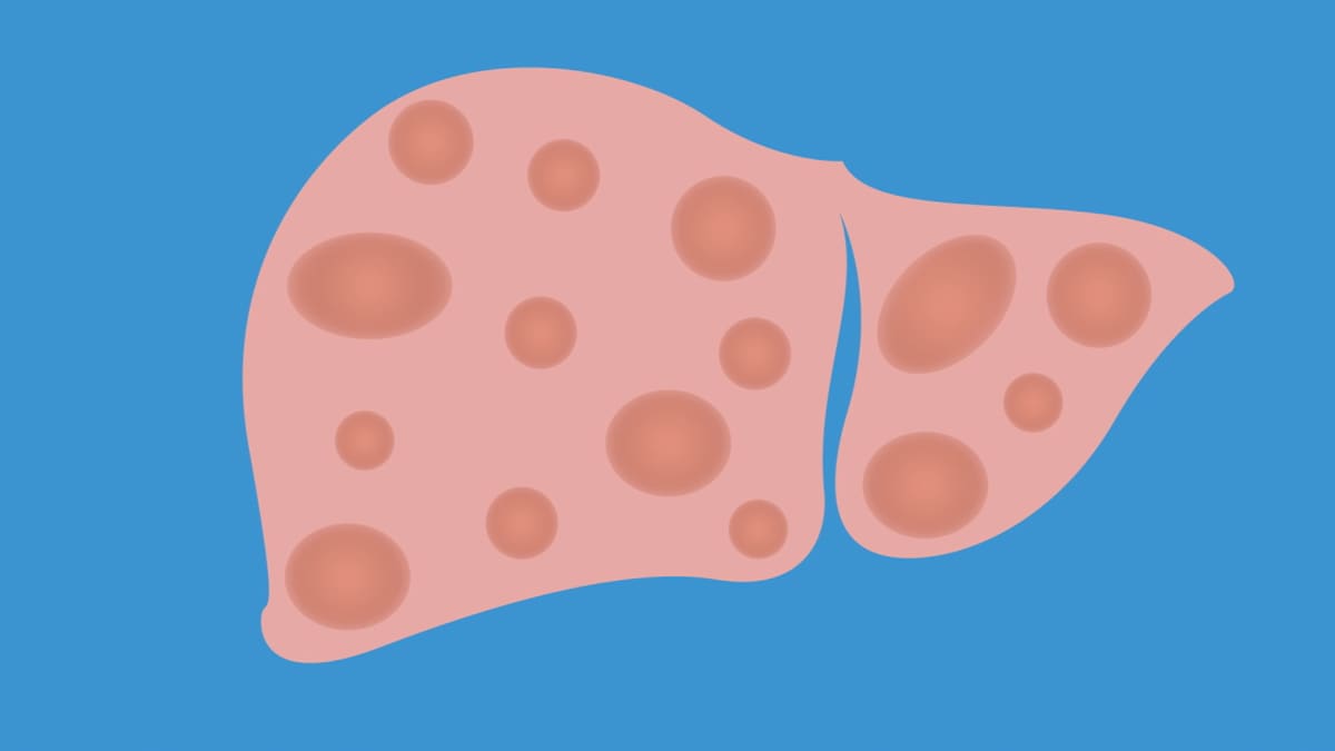 Жировий гепатоз: основні симптоми накопичення жиру в печінці