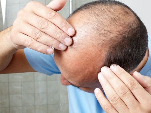 Пересадка волос – профессиональные методики с гарантией качества