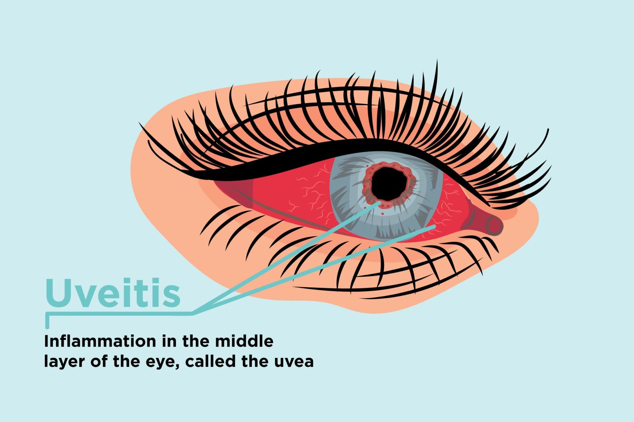 Увеїт: симптоми запалення оболонки ока