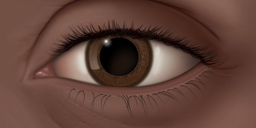 Анізокорія: причини різних за розміром зіниць ока