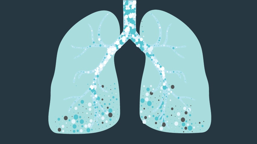 Основні симптоми легеневого фіброзу