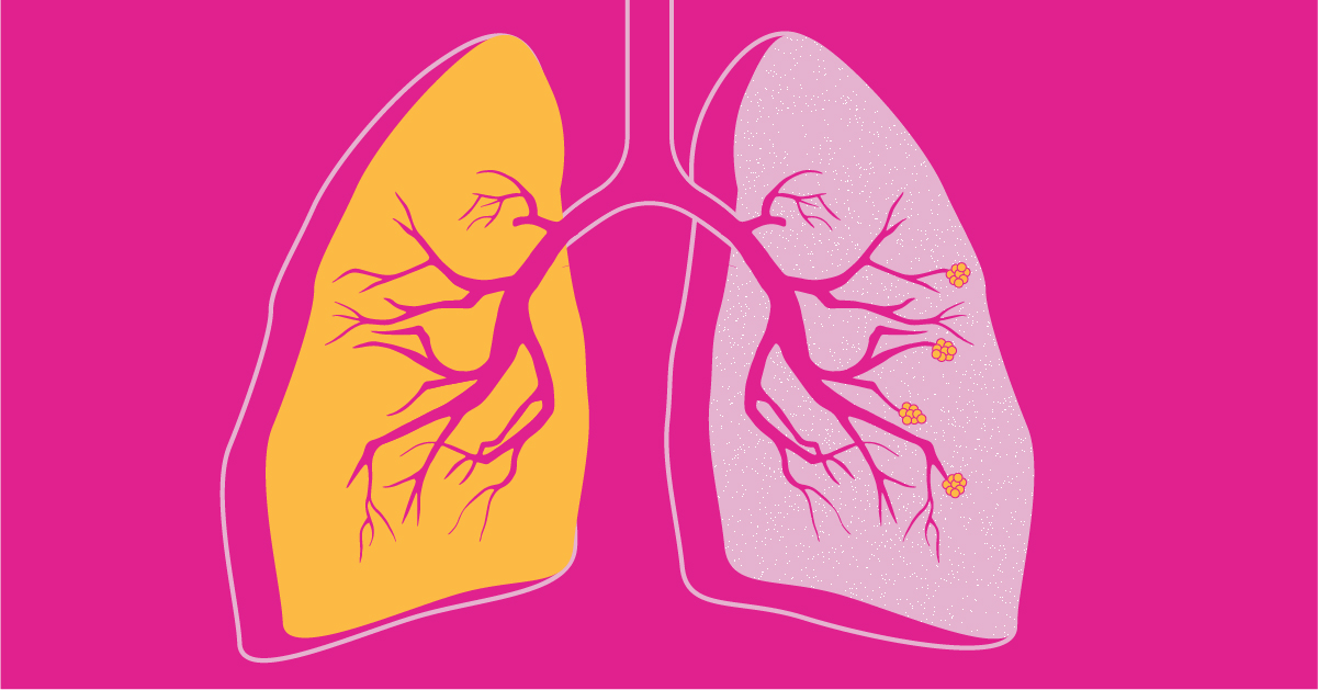 Емфізема: основні причини здуття легень