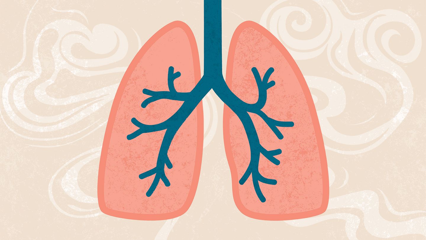 Пневмонія: які симптоми вказуватимуть на розвиток запалення легень?