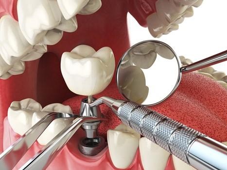 Скільки коштує імплантація зубів: від чого залежить та як може відрізнятись ціна в різних клініках