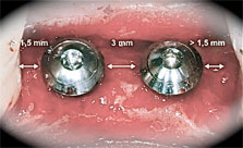 Имплантация при частичной потере зубов